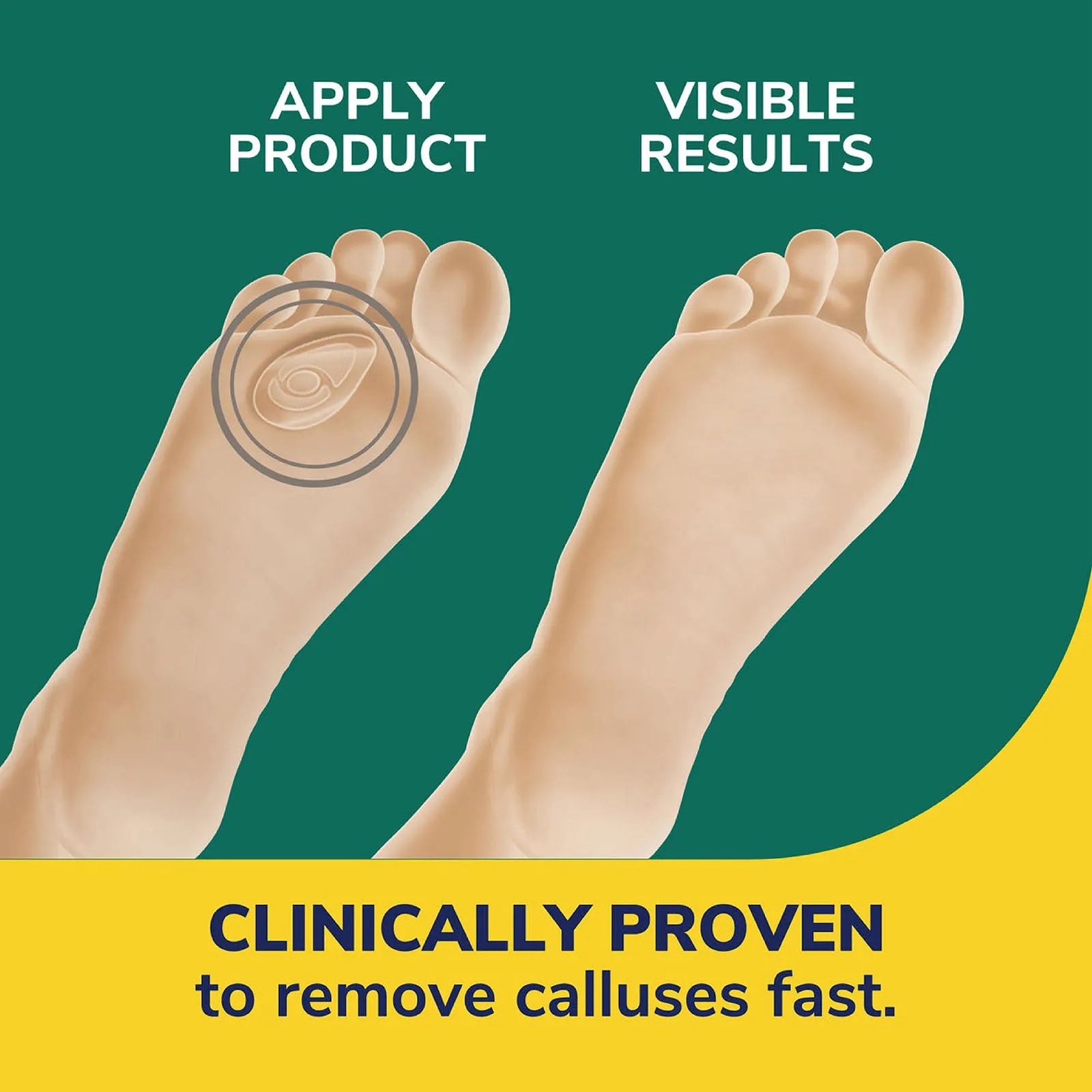 Dr.Scholl Callus Removers Seal & Heal Bandage with Hydrogel Technology